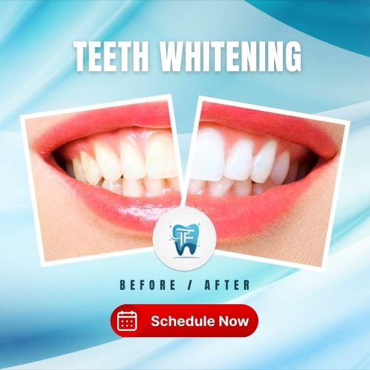 teeth whitening